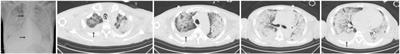 Application of Extracorporeal Membrane Oxygenation in Patients With Severe Acute Respiratory Distress Syndrome Caused by Pneumocystis jirovecii Pneumonia Following Kidney Transplantation: A Case Series